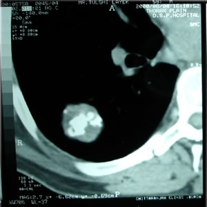 CT Scan of chest dated 04.08.2000