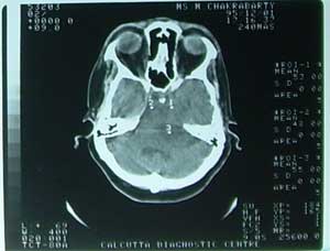 C.T. Scan of Brain dated 01.12.1995