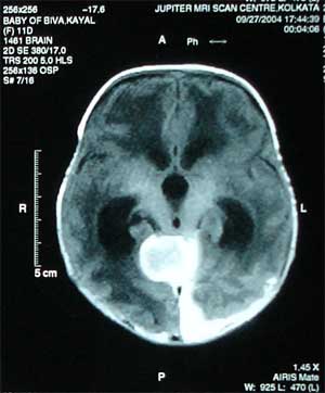 MRI of Brain dated 27.09.2004