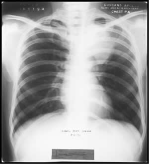 Chest X-ray dated 18.11.1994
