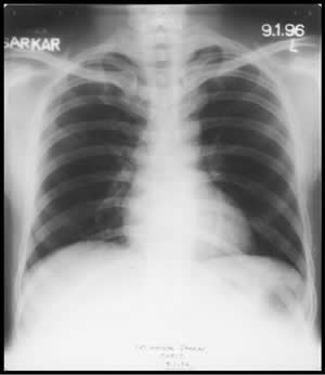 Chest X-ray dated 05.07.1995