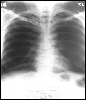 Chest X-ray dated 05.07.1995