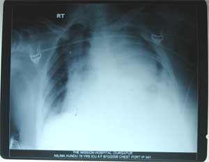 Chest X-ray dated 12.06.2008