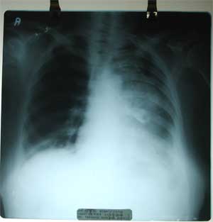 Chest X-ray dated 21.08.2008 