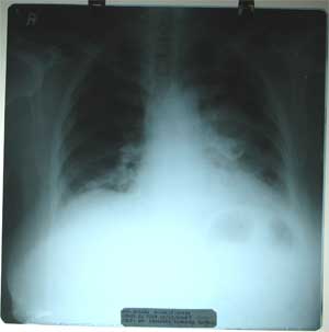 Chest X-ray dated 13.01.2009