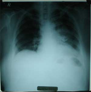 Chest X-ray dated 13.10.2009 