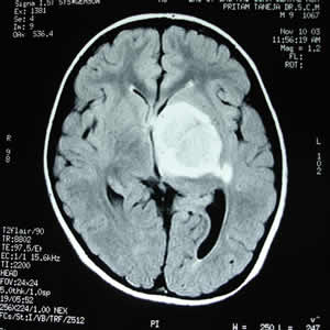 MRI of brain dated 10.11.2003