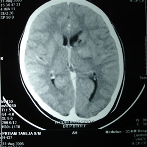 C.T. Scan of Brain Dated 11.08.2005