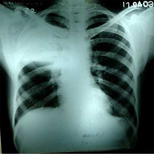 Chest X-ray dated 17.04.2003