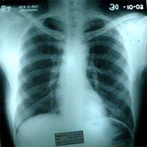 Chest X-ray dated 30.10.2003