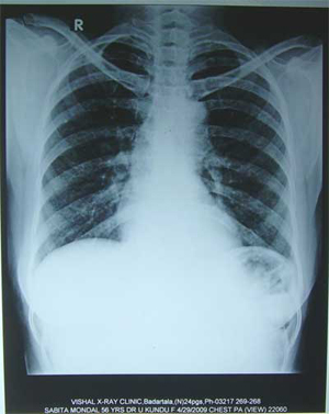 Chest X-ray dated 29.04.2009