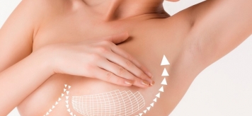Особенности ниточного лифтинга: мастопексия груди нитями