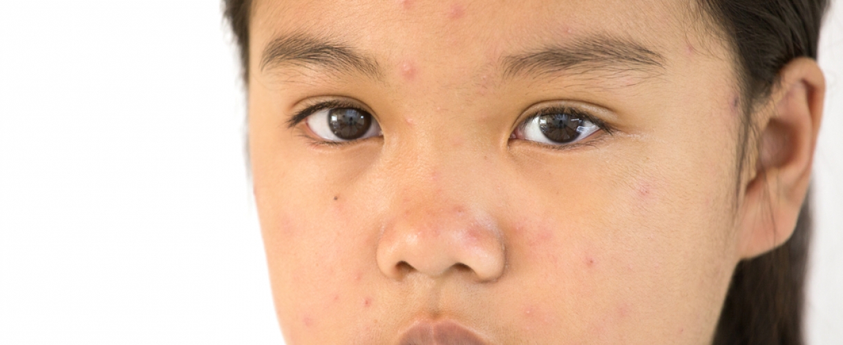 Сыпь на лице – почему она появляется и как с ней бороться