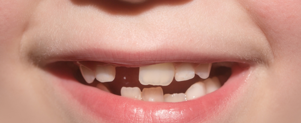Кривые зубы: предрасполагающие факторы, методы исправления и профилактика
