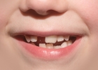 Кривые зубы: предрасполагающие факторы, методы исправления и профилактика