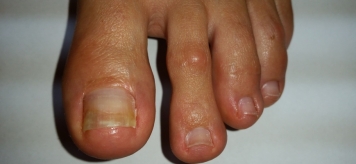 Почему отходят ногти на ногах и как их лечить