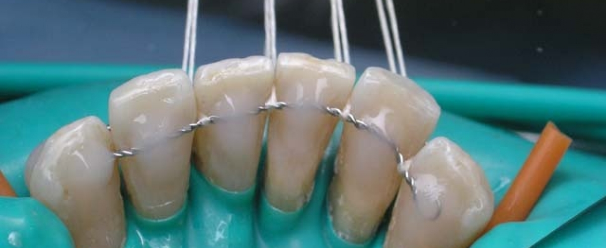 Шинирование зубов: особенности процедуры