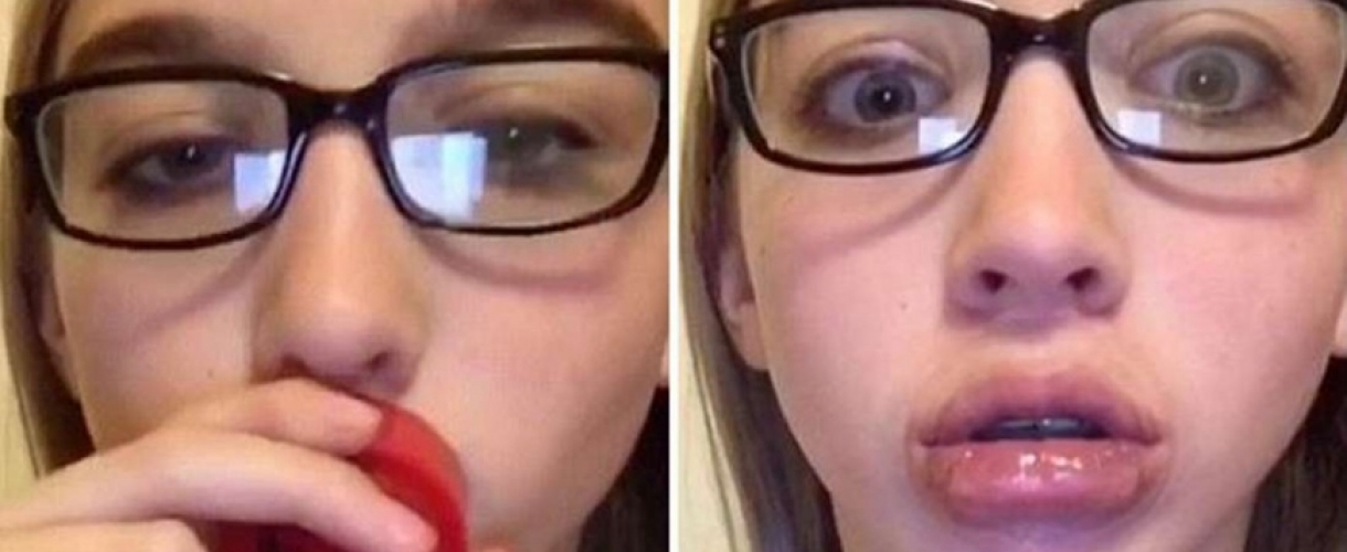 Как увеличить губы и надо ли это делать