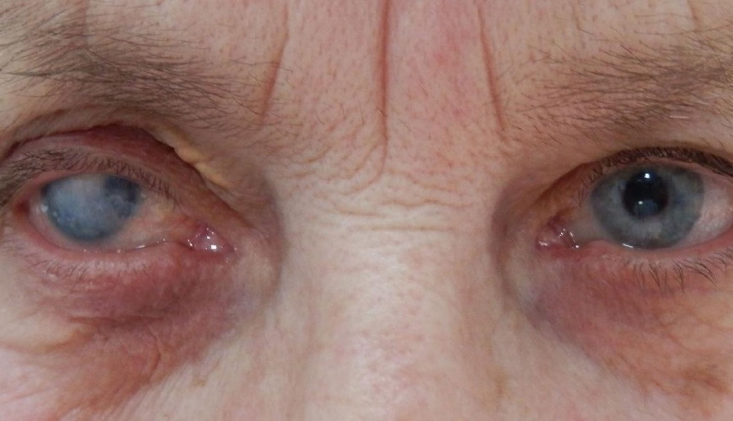 Причины и лечение бельма на глазу
