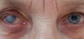Причины и лечение бельма на глазу