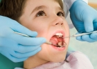 Кариес молочных зубов: рекомендации стоматолога