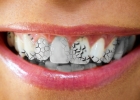 Зубной камень: причины образования и методы удаления