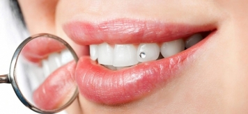 Украшения на зубах как повод привлечь внимание окружающих
