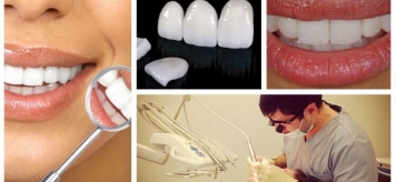 Эстетические реставрации зубов керамическими винирами