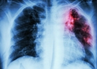 Туберкулез: факты и мифы о заболевании