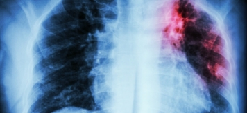 Туберкулез: факты и мифы о заболевании