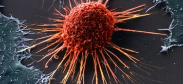 Рак будет полностью побежден через 50 лет, или Чем вооружились врачи в войне с онкозаболеваниями