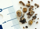 Песок сыпется: ультразвуковая диагностика камней в почках