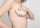 Увеличение груди жиром: секреты пластического хирурга