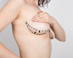 Увеличение груди жиром: секреты пластического хирурга