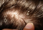 Обзор 5 распространенных заболеваний волос и кожи головы