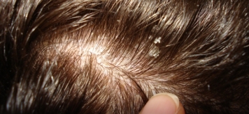 Обзор 5 распространенных заболеваний волос и кожи головы