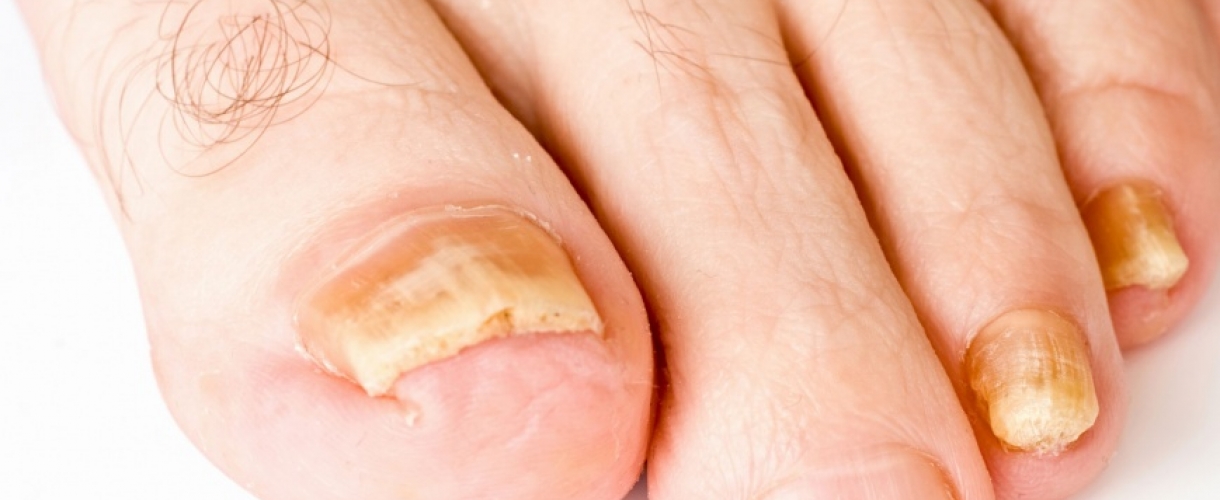 Три способа вылечить грибок ногтей