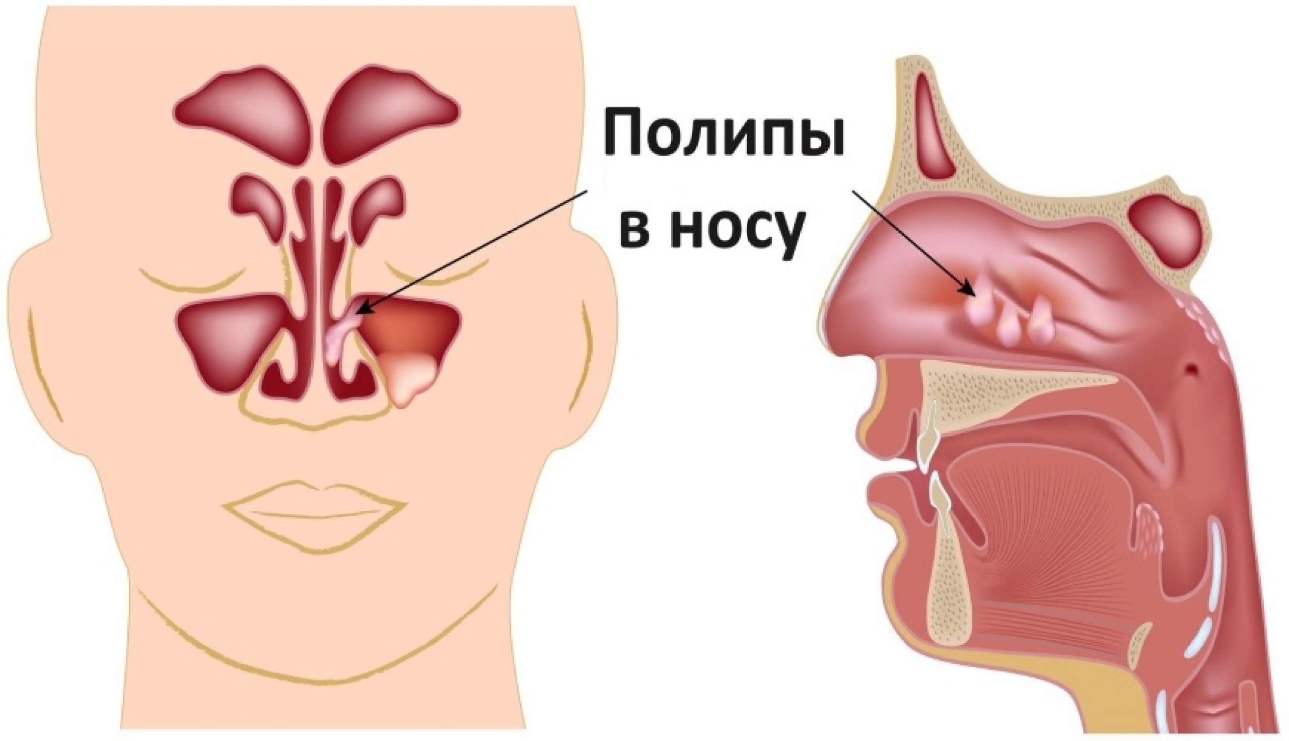 Способы лечения полипов в носу
