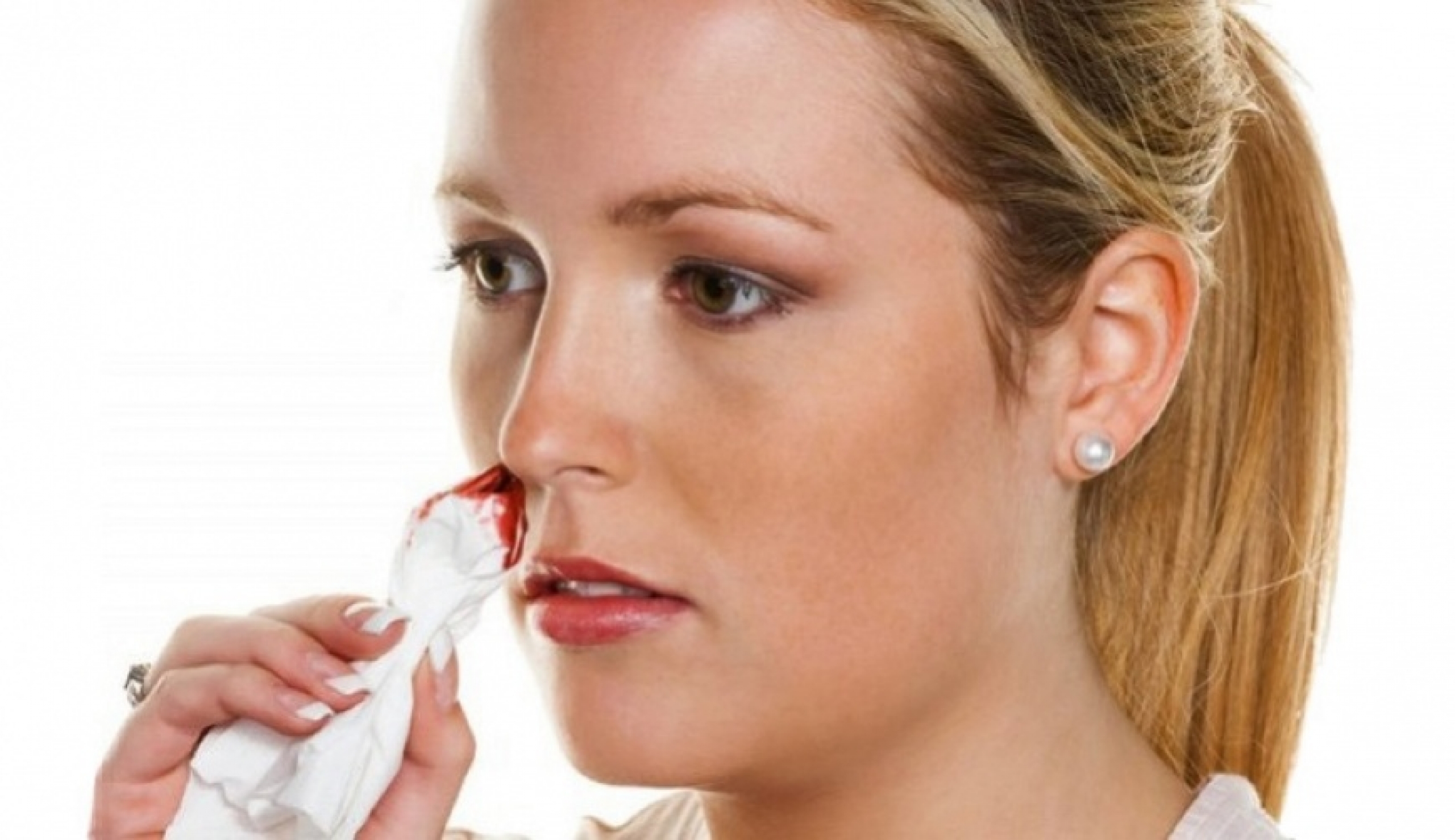 Причины и первая помощь при носовом кровотечении