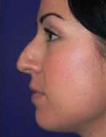 Нос с горбинкой фото 1
