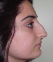 Нос с горбинкой фото 3