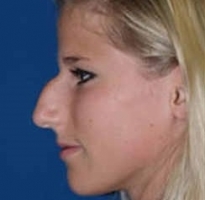 Нос с горбинкой фото 2
