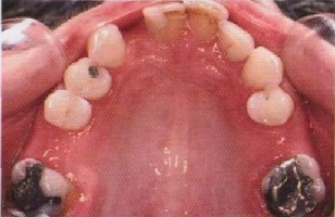 Дефекты зубных рядов фото 3