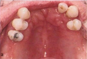 Дефекты зубных рядов фото 1