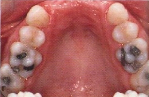 Дефекты зубных рядов фото 4
