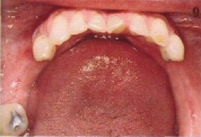 Дефекты зубных рядов фото 2