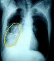 Пневмония фото 3