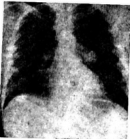Атипичная пневмония фото 3