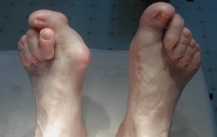 Молоткообразные пальцы стопы фото 2