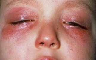 Аллергический конъюнктивит